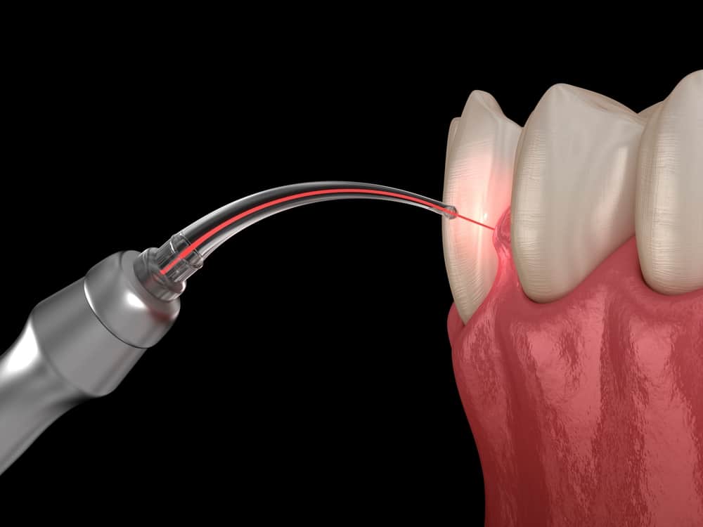 Gum,Correction,Surgery,With,Laser.,Dental,3d,Illustration